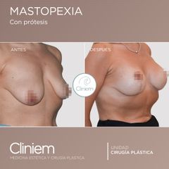 Mastopexia - Cliniem