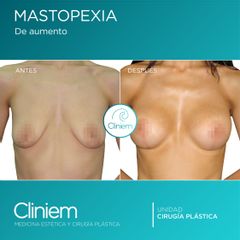 Mastopexia - Cliniem