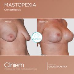 Mastopexia - Cliniem