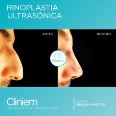 Rinoplastia - Cliniem