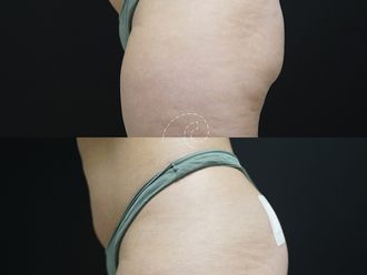 Aumento glúteos antes y después - 876362