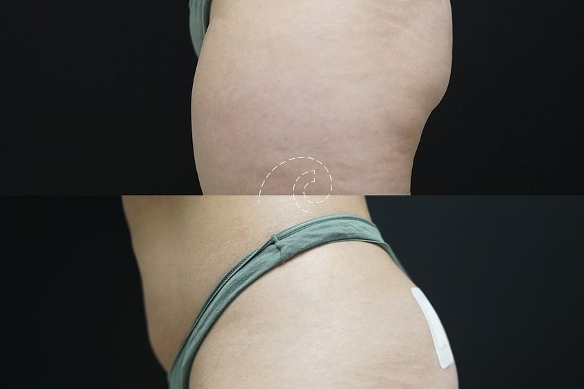 Aumento glúteos antes y después - 876362
