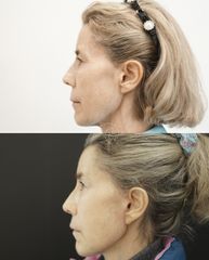 Lifting Facial - Cliniem