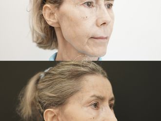 Lifting antes y después - 876364