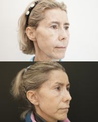 Lifting Facial - Cliniem