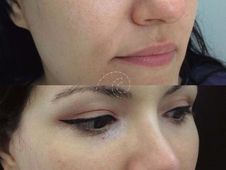 Rinoplastia antes y después - 876390