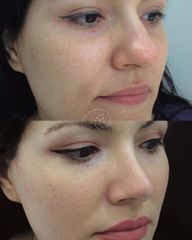 Rinoplastia - Cliniem