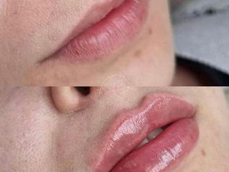 Aumento labios antes y después - 879994