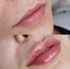 aumento de labios - Cliniem