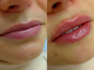 Aumento labios antes y después - 879995