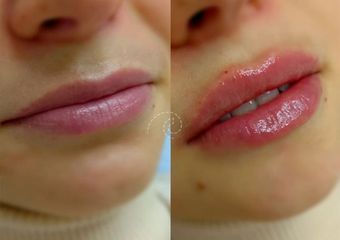 Aumento de labios - Cliniem