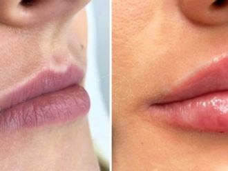 Aumento labios antes y después - 880000