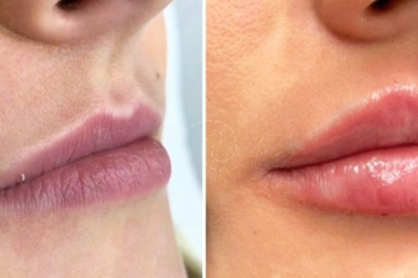 Aumento labios antes y después - 880000
