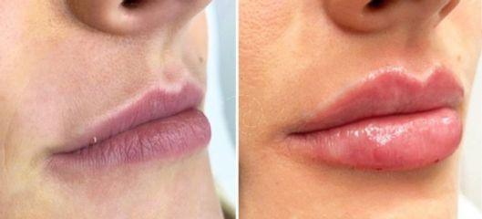 Aumento de labios - Cliniem