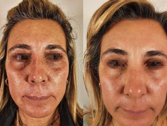 Rejuvenecimiento facial antes y después - 880111