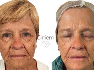 Rejuvenecimiento facial antes y después - 880112
