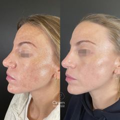 Melasma