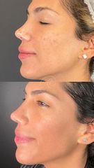Melasma