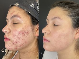 Tratamiento antiacné antes y después - 880115