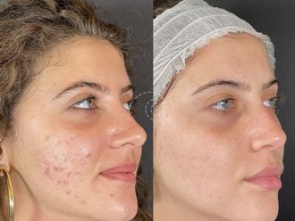 Tratamiento antiacné antes y después - 880116