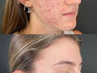 Tratamiento antiacné antes y después - 880117