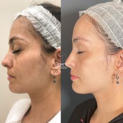 Melasma