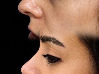 Rinoplastia antes y después - 880119