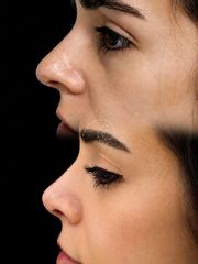 Rinoplastia