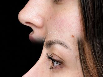 Rinoplastia antes y después - 880120