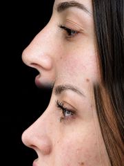 Rinoplastia