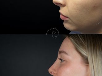 Rinoplastia antes y después - 880139