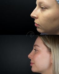 Rinoplastia