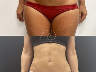 Lipoescultura antes y después - 880140