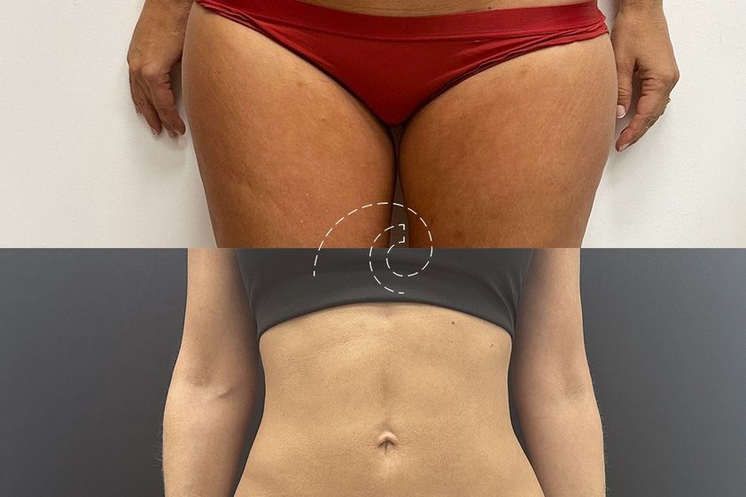 Lipoescultura antes y después - 880140