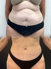 Abdominoplastia
