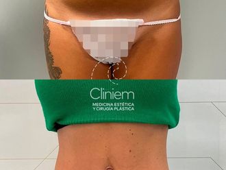 Abdominoplastia antes y después - 880146