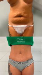 Abdominoplastia