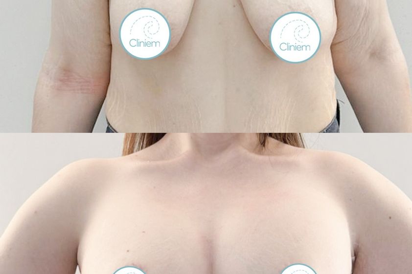 Mastopexia antes y después - 880147