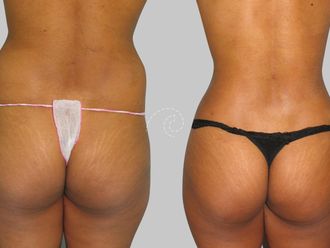 Lipoescultura antes y después - 880148