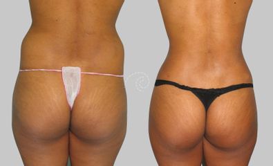 Lipoescultura