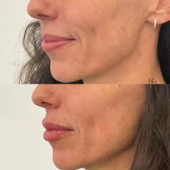Tratamiento aumento de labios - Dra. Eva Garrigos