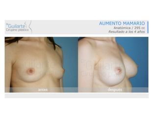 Antes y después Aumento de pecho