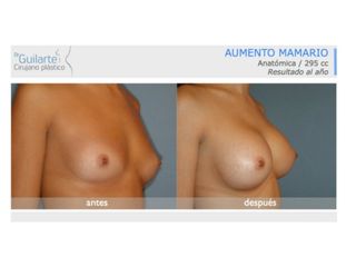 Antes y después Aumento de pecho