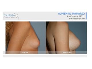 Antes y después Aumento de pecho