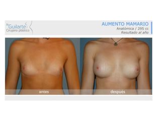Antes y después Aumento de pecho