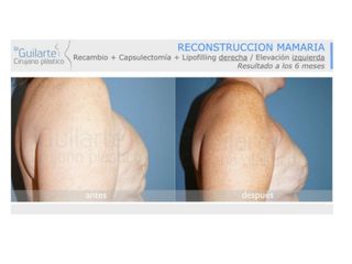 Antes y después Reconstrucción mamaria