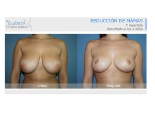Antes y después Reducción de senos