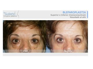Antes y después Blefaroplastia
