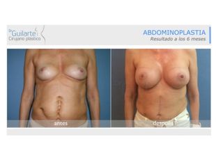 Antes y después Abdominoplastia