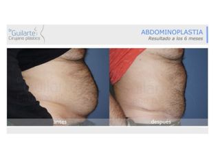 Antes y después Liposucción